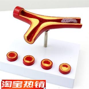ENOVO颐诺冠状动脉p性心血管动脉硬化模型老年心脏模型血栓心内科