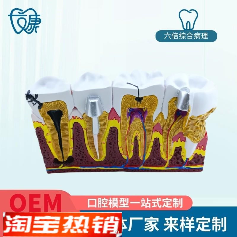 综合病理模型成人牙周切面v牙齿模型病理牙神经口腔牙科教学摆件