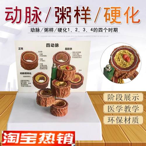 血管/堵塞动支脉粥样q/硬化心血管动脉/硬化模型血管病理模型血栓