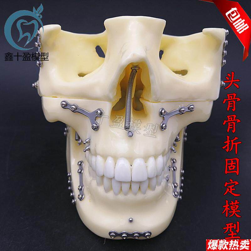 牙科种植支抗钉模型D头颅骨折固定模型头颅骨口腔模型医学教学