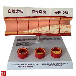人体血管斑块狭窄粥样硬化心血管动脉硬化模型X血栓人体教学