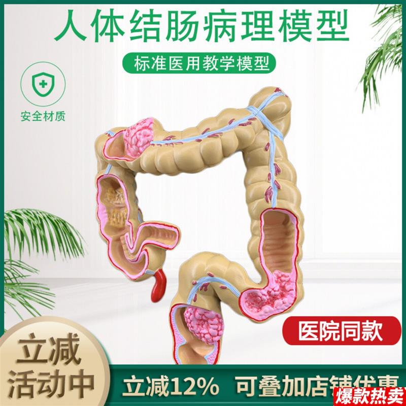 人体结肠病变模型肛肠科消化内科大肠模型医s学人体解剖模型包邮