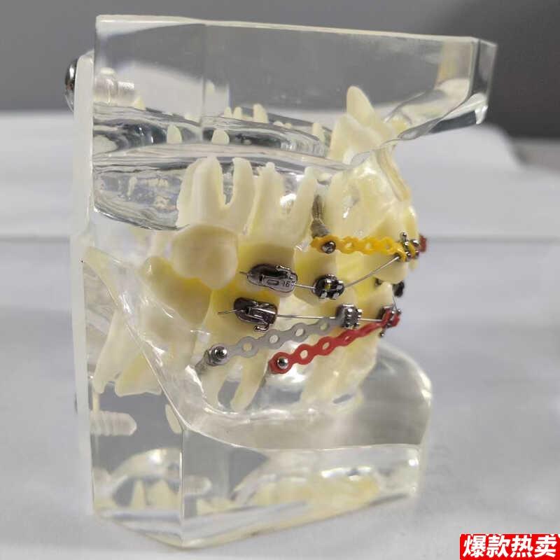 透明正畸撮合矫正z模型透明水晶托槽展示结扎丝托槽正畸带支抗钉