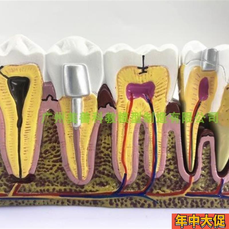 牙科口腔6倍综合病理模型 龋齿解剖根管及牙R神经展示教学模型