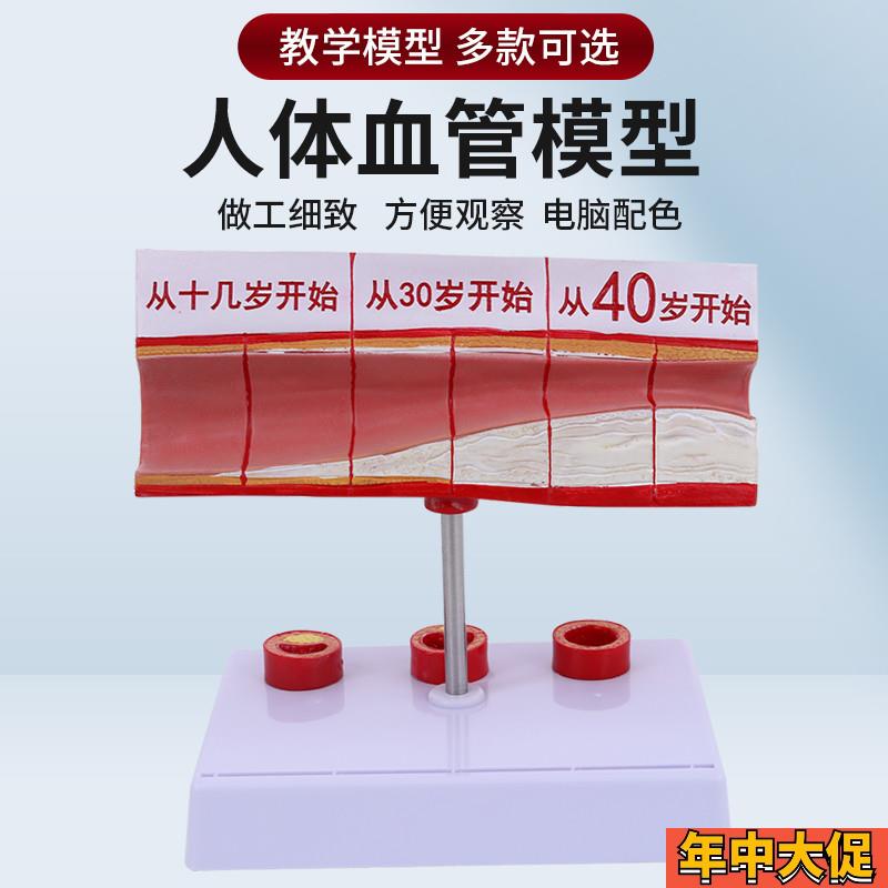 人体血管解剖模型 血管模型 硬化动脉展J示 各阶段年龄层血管演示