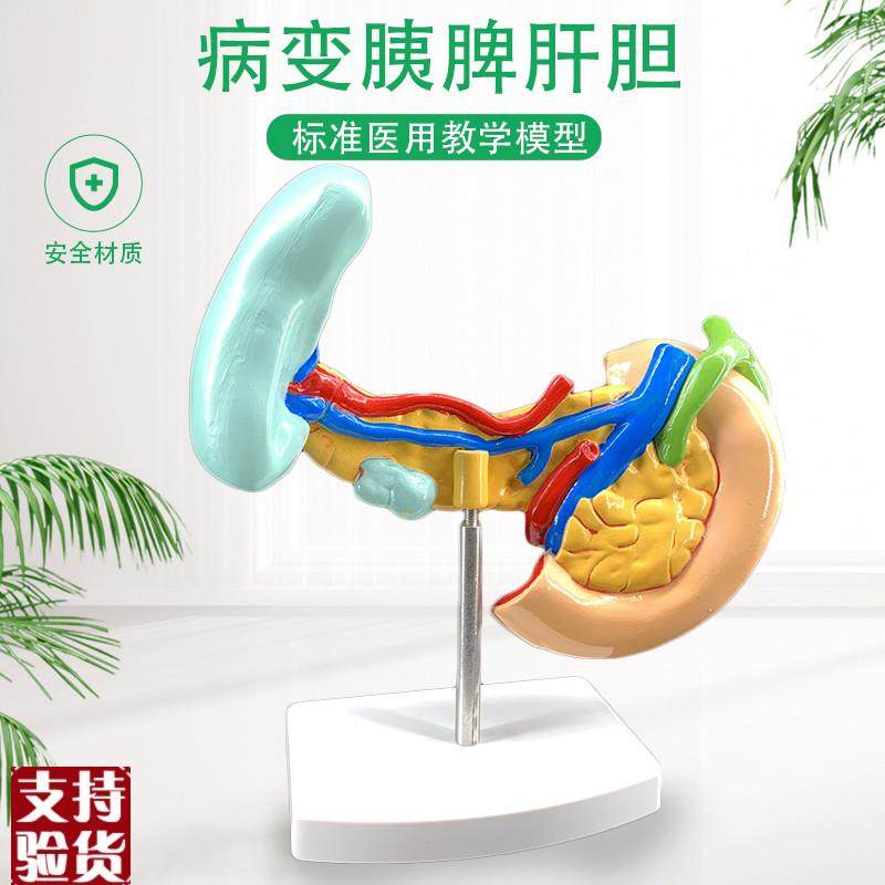 病变胰脾肝胆十二指肠模型u病理标本胰脾肝胆人体器官解剖教学模,玩具/童车/益智/积木/模型,其他模型玩具,淘宝优惠券,粉丝福利购,淘宝优惠卷