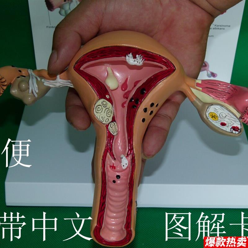 子宫卵巢病理病变模型生殖科医S药礼品模型女性子宫阴道模型