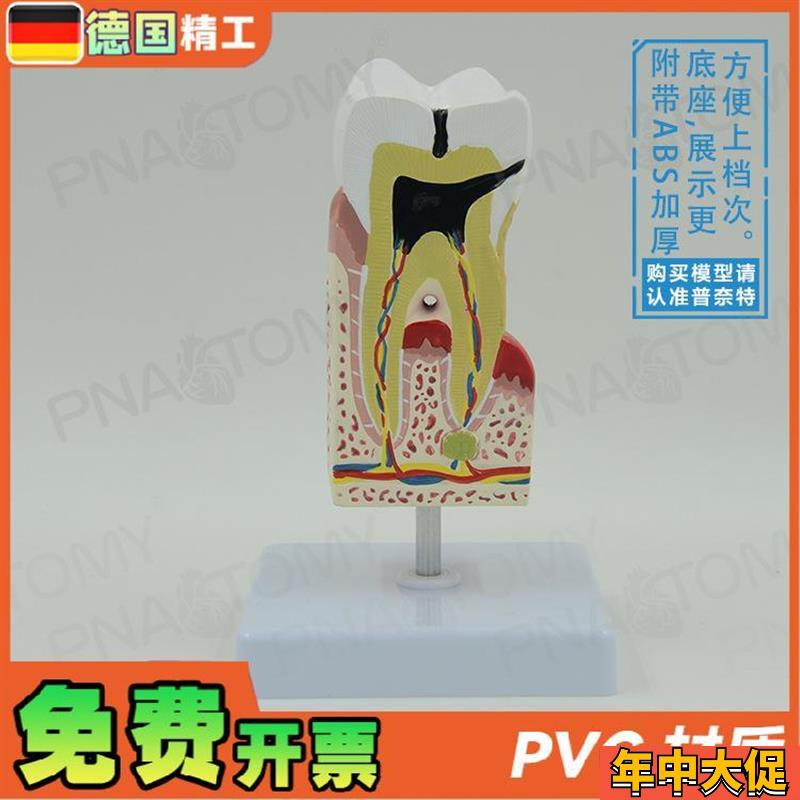 德国】人体牙f齿模型蛀牙龋齿解剖口腔科牙科 教学牙神经医患沟通
