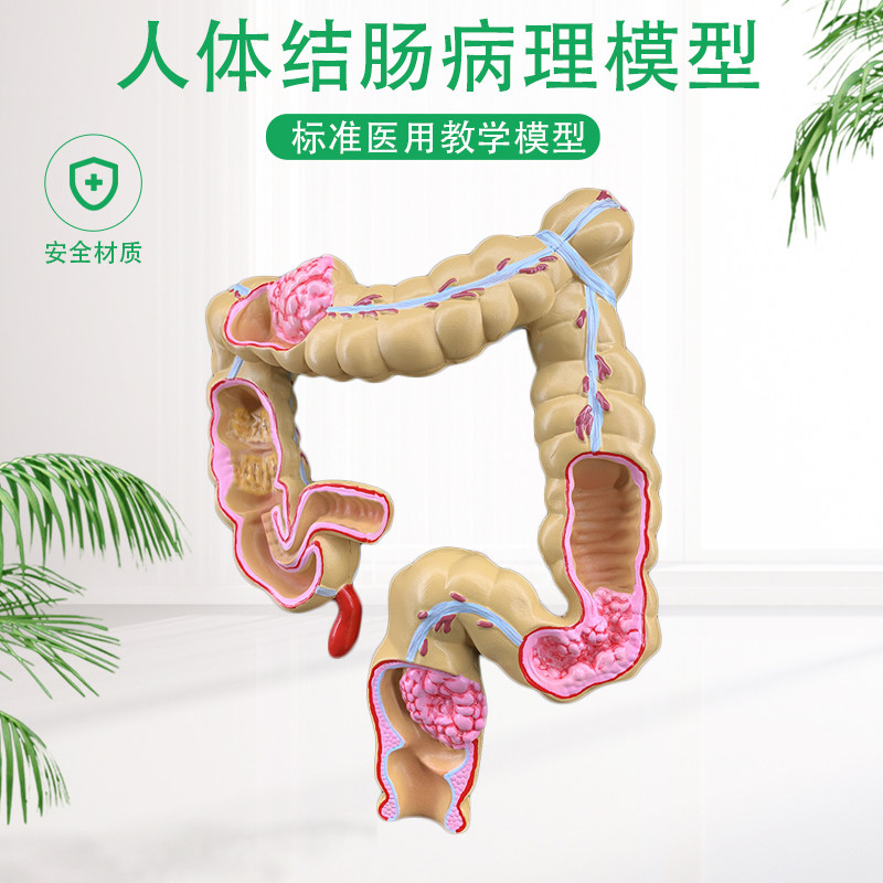 人体结肠病变模型肛肠科消化内科大肠模型医学人T体解剖模型包邮