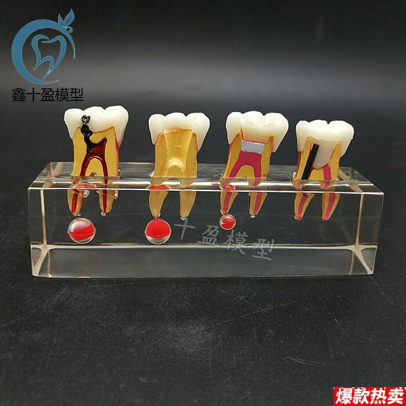 牙科教学模型乳牙龋病模E型可拆分牙髓修复医患沟通M4018包邮