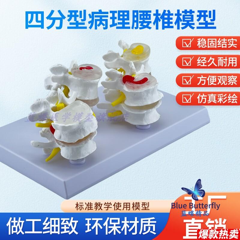 四分型脊椎正常与病变q腰椎组合模型椎间盘病理腰椎演示过程病变