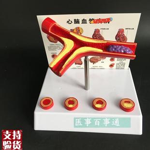动脉模型心病血管解剖面模型血管模型血O管解剖模型教学包邮