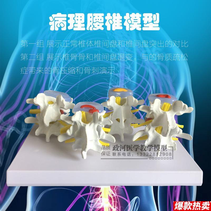 教学彷真病理脊椎模型四分型脊T椎正常与bing变腰椎组合模型脊椎