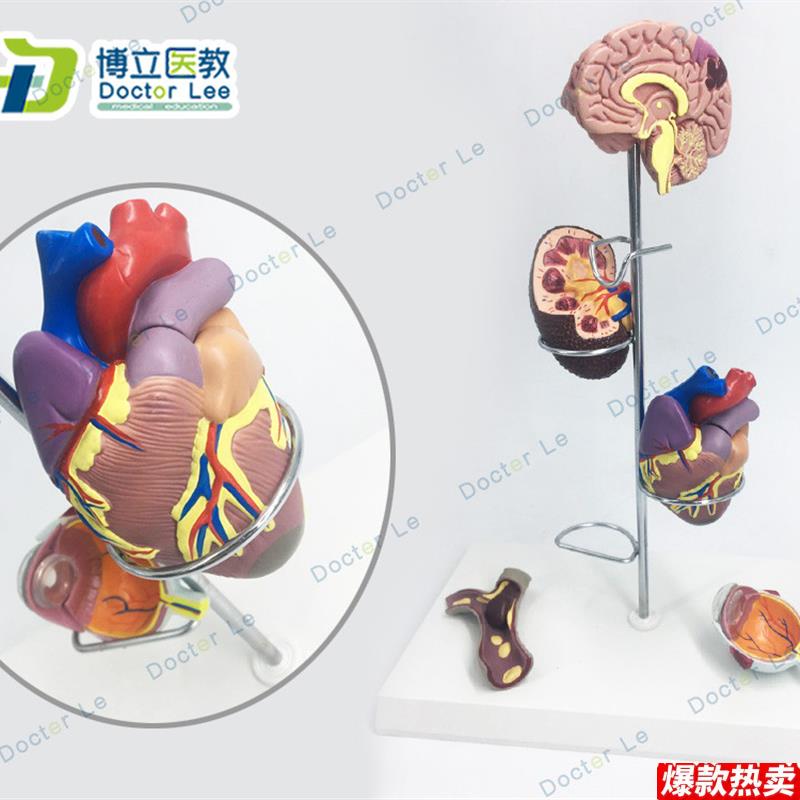 人体高血压模型高血压大脑心脏血管内科普外科医E生礼品大脑