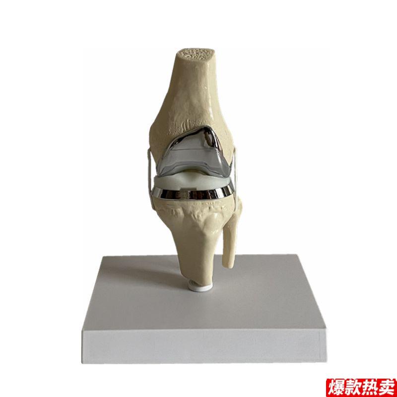 膝关节仿真人工假肢模型半月Z板软骨手术示教单髁全膝置换演示医
