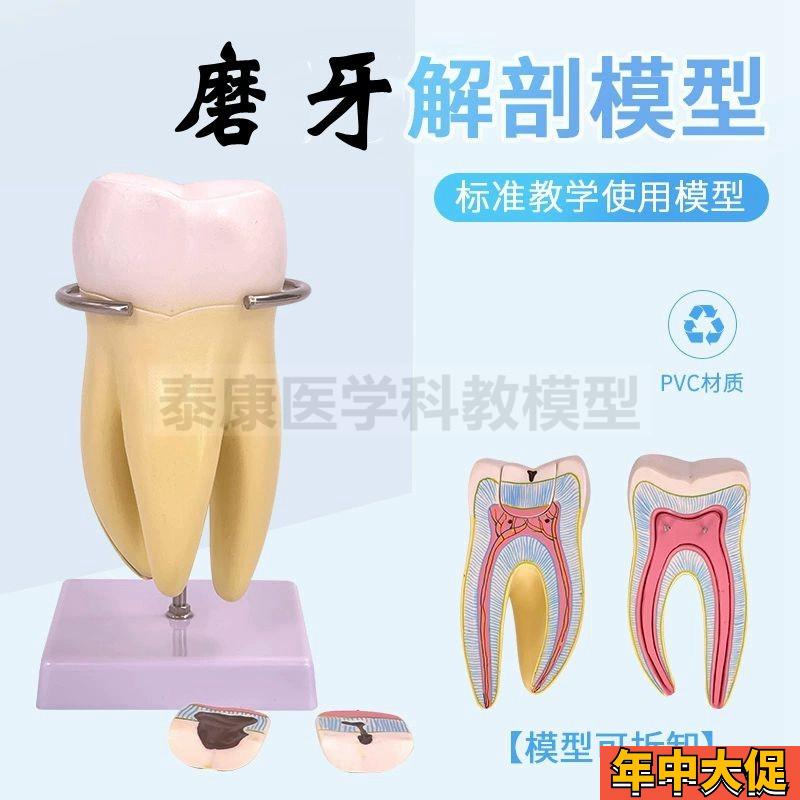 蛀牙模型黑牙龋j齿变化口腔牙科医用大型磨牙可拆卸牙髓牙根牙医
