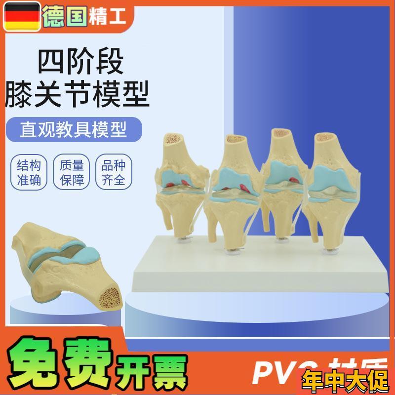 德国】人体膝关节模型 正常与病理D对比教具 医药礼品医患沟通道