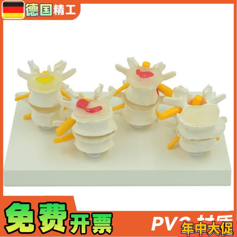 德国】4阶段病变腰椎模型 人体骨骼解剖Q椎体医学教学器材