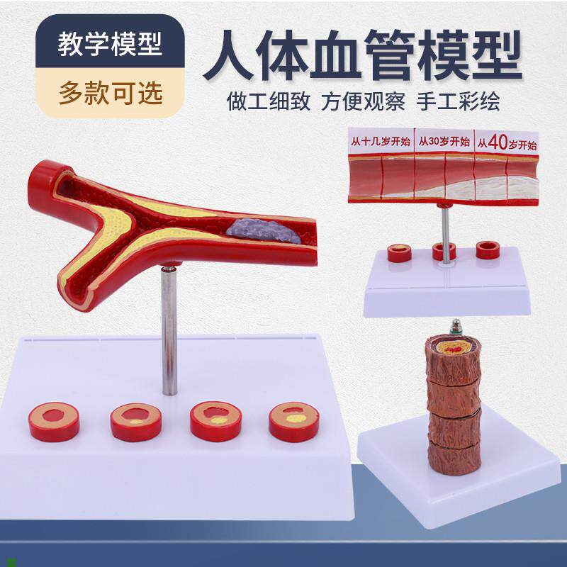血管堵塞动支脉粥样硬化心血管模型堵塞程度变化W病理血管模型