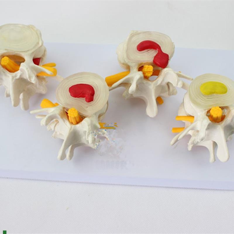 人体四阶段病g态正常腰椎比较病变骨骼标本模具病理模型