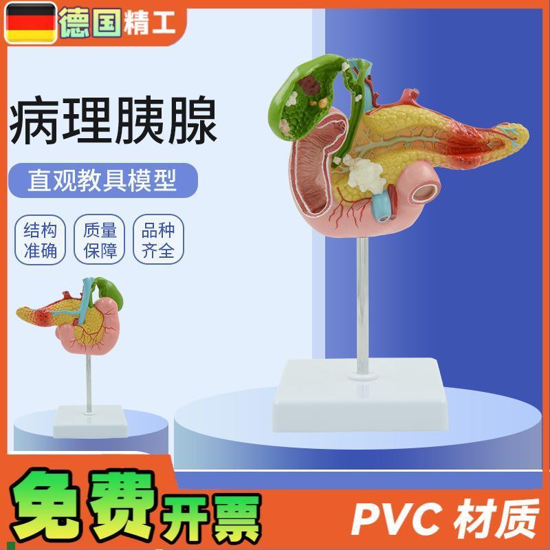 德国】教学仿真病变胰脾肝胆十二指肠模型Q病理胰腺标本胰脾肝