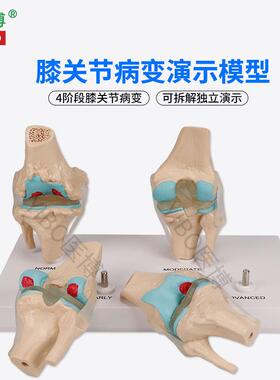 医博BIX-A3571膝关节病变模型人体骨骼病变模型人体R膝关节4阶段