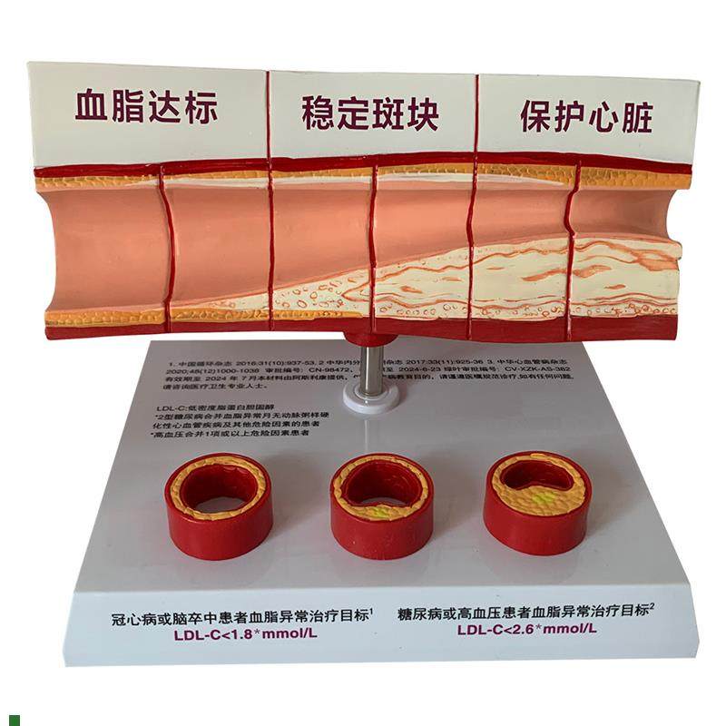 血管活动堵塞动支脉粥样硬化w心血管动脉硬化模型血管病理模型血