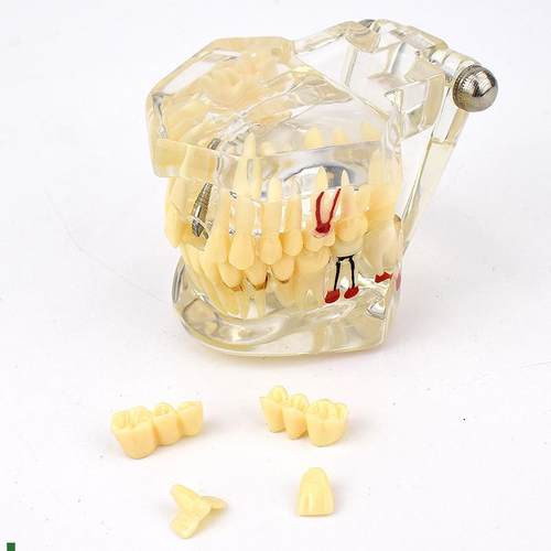 ENOVO颐诺口腔模型r齿科种植阻生齿牙体牙髓口腔教学马里兰桥瓷贴