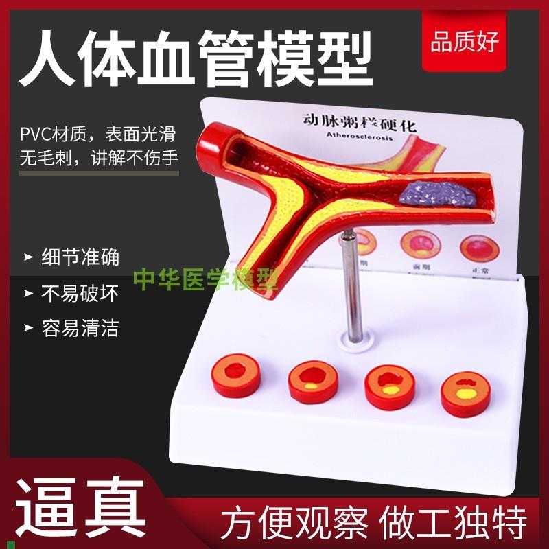 血管/堵塞动e支脉粥样/硬化心血管动脉/硬化模型血管病理模型血栓