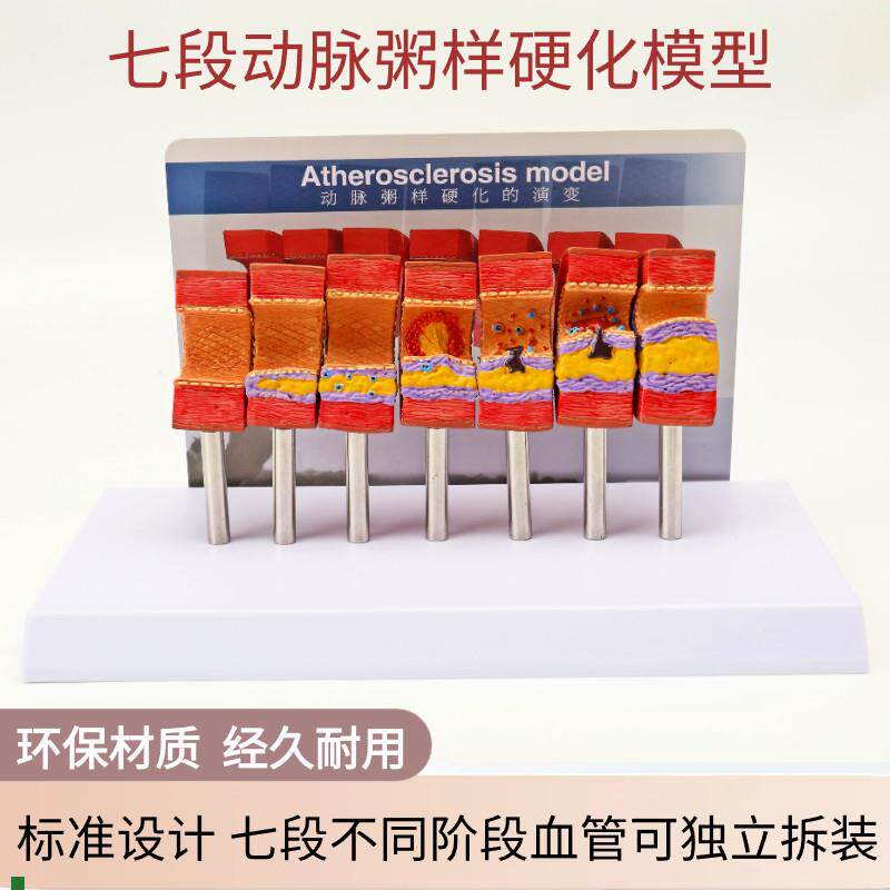 动脉粥样硬化g模型血管血栓栓塞模型动脉血管人体医用医学教学模