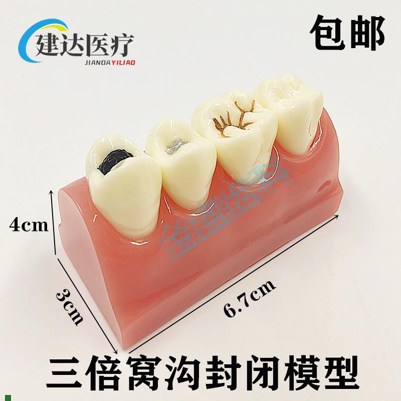 牙科教学模型窝沟封闭模型儿童防蛀龋H坏牙齿模型窝沟封闭操作示