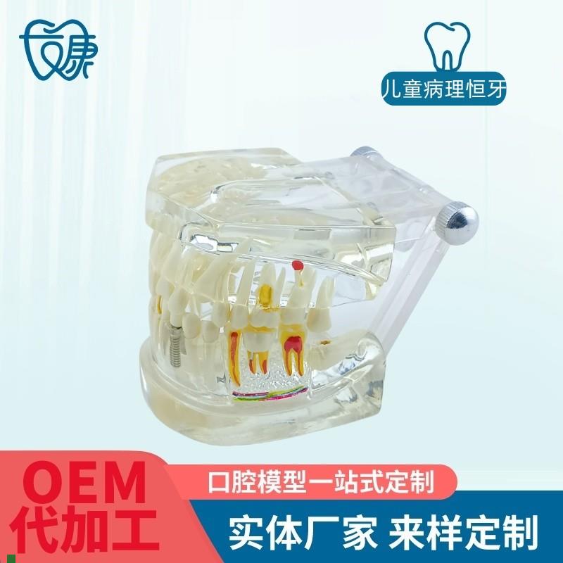 牙齿模型病理修复可拆卸t正畸口腔病理牙模型牙科医患活动沟通