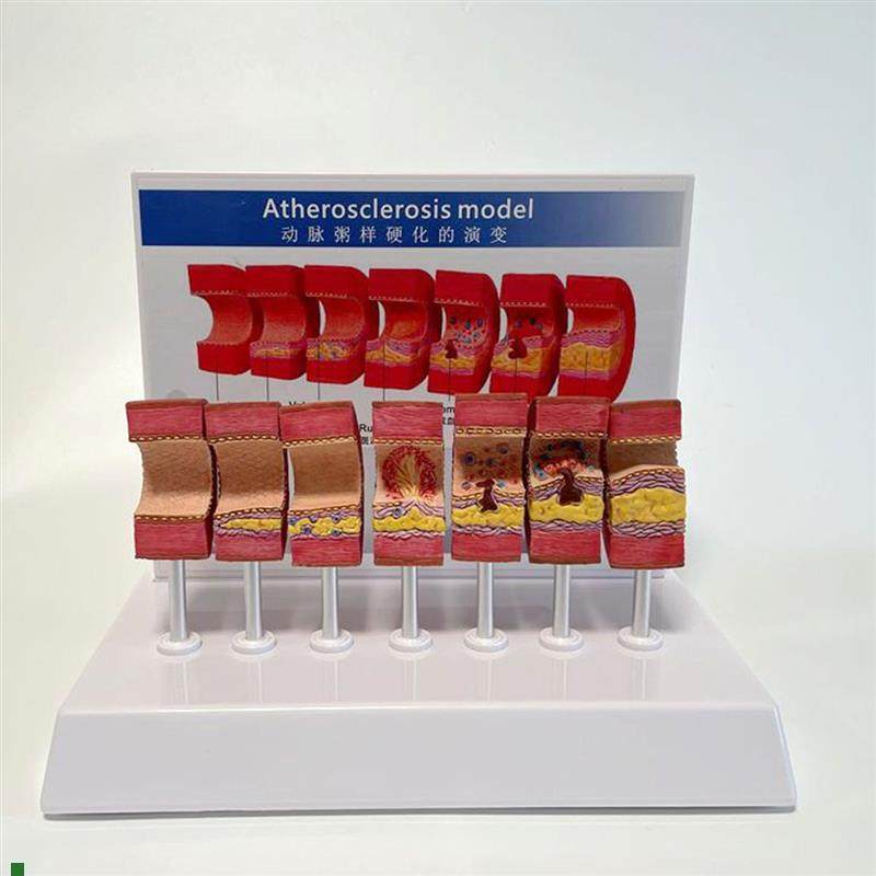 动脉血管模型粥j样病理硬化血管壁变细狭窄内膜斑块沉积阻塞程度