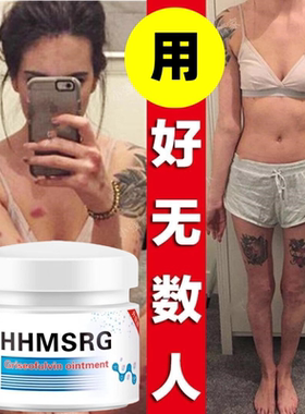 【正品】伊曲康唑乳膏同效人用复方伊曲康挫真菌软膏外用正品药膏