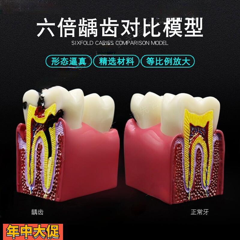 牙科口腔模型解剖放大蛀牙模具医患沟通六倍牙齿龋坏病理演示