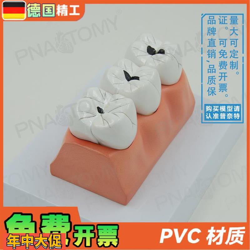 德国】牙科牙齿龋齿解剖分解模型口腔科牙科病理蛀牙模型教学展