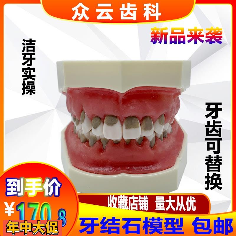 牙科口腔练习牙结石龈上龈下刮治模型牙结石牙周病理牙齿模型