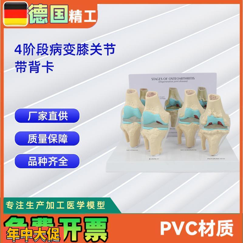 4阶段膝关节模型带背卡病变膝关节模型骨科教学展示教具