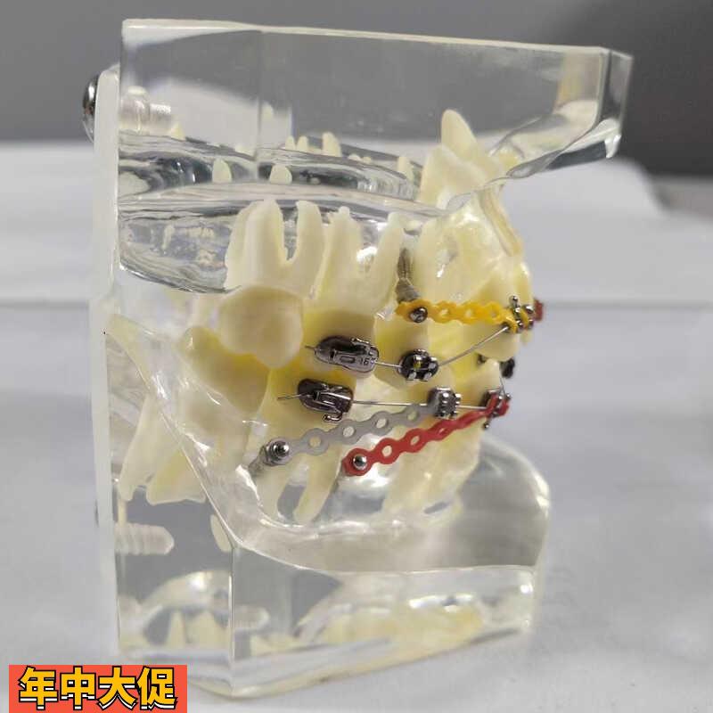透明正畸撮合矫正模型透明水晶托槽展示结扎丝托槽正畸带支抗钉牙