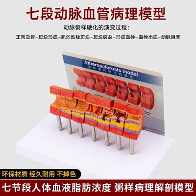 仿真人体a心脑血管动脉粥样硬化堵塞模型血栓血液脂肪病理解剖教