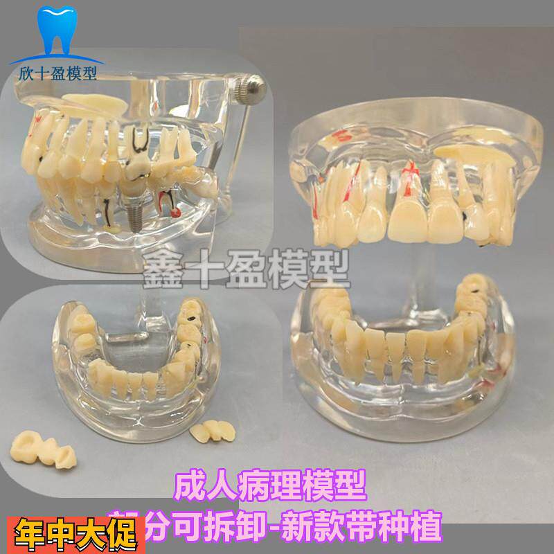 牙科牙齿病理模型成人全口牙模型牙模医患沟通教育教学种植修复C4