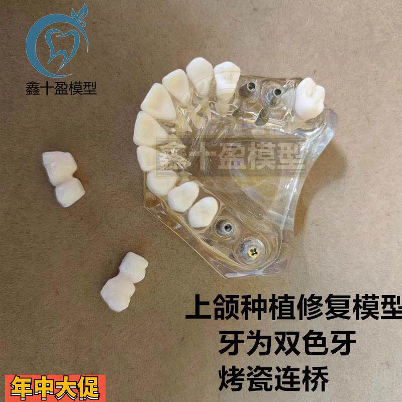 牙科种植模型2011上颌种植解说义齿修复烤瓷连桥种植钉模型