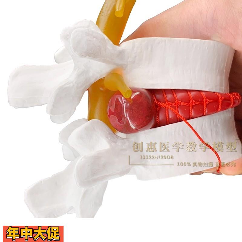 腰椎间盘tu出演示模型脊柱模型医用按摩推拿腰椎模型包邮