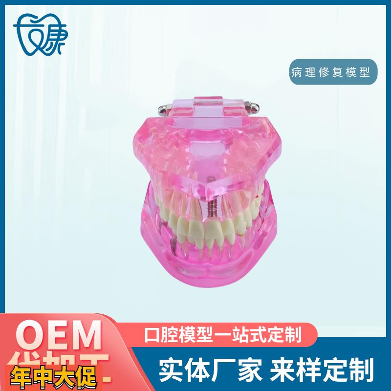 牙齿模型病理修复可拆卸正畸口腔病理牙模型牙科医患活动沟通