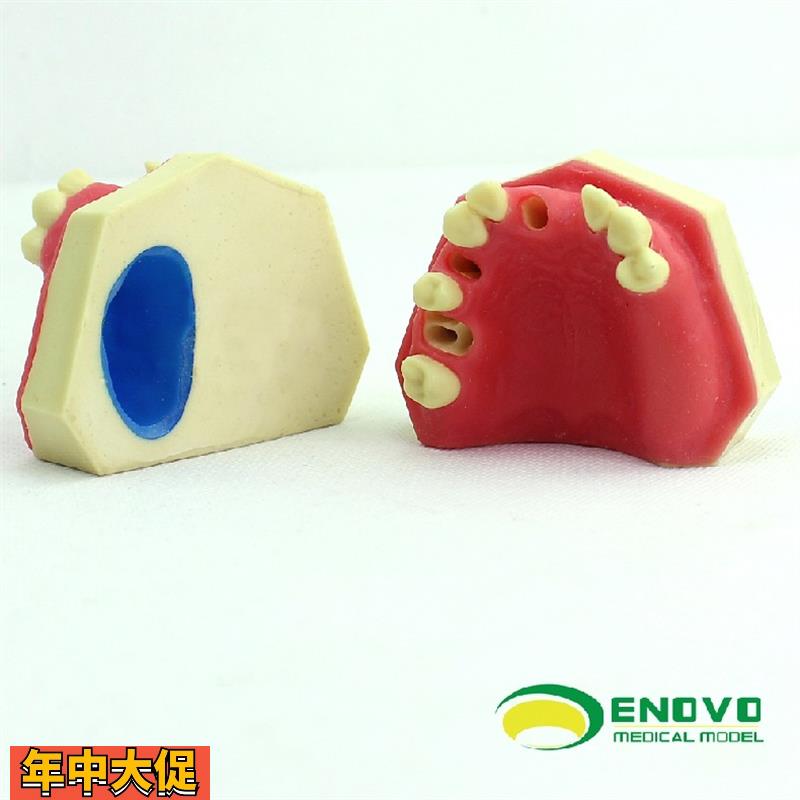 ENOVO颐诺口腔即刻种植练习操作模型上颌骨上颌窦牙列缺失种植体