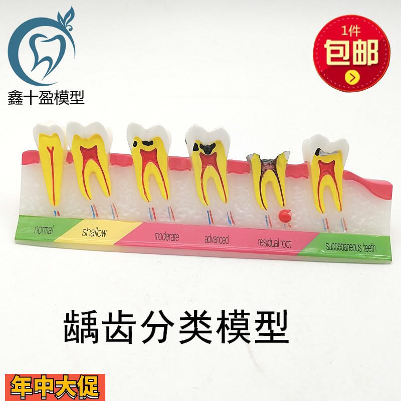 牙科口腔教学龋齿分类模型牙齿龋坏病变变演示讲解医患沟通M7