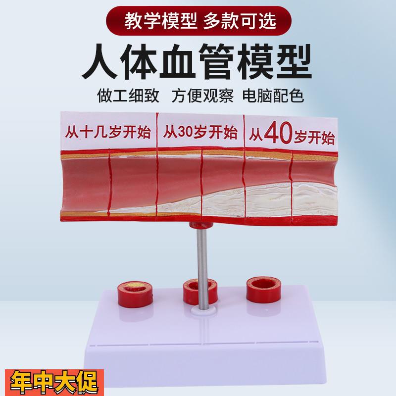 人体梗化支脉粥样心血管动脉解剖梗化模型血管血全形成模型