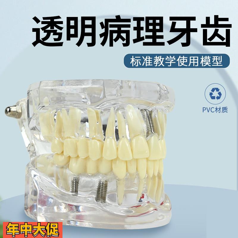 牙科修复模型口腔科病理医患沟通教学修复体综合带神经可拆卸牙模