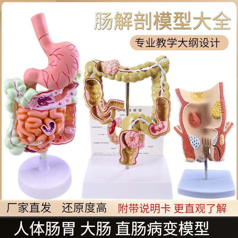 大肠病理模型肠胃病变解剖模型直肠模型肠道疾病人体结肠病理模型
