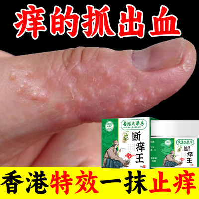 手上起小水泡汗状疱疹真菌感染止痒药膏专用软断痒王特效皮肤瘙痒